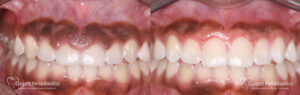 Gummy Smile Patient 3 Teeth