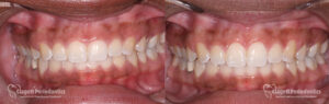 Gummy Smile Patient 4 Teeth