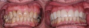 Dental Implants Patient 5 Teeth