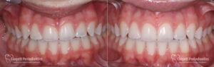 Gummy Smile Patient 5 Teeth